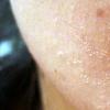 Причины шелушения кожи в результате перелома Почему после операции шелушится кожа